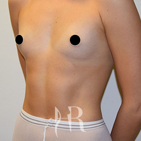 HR Plastic Surgery - Breast Enlargement patient before 5
